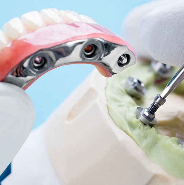 implant denture prep Edmonton denture clinic